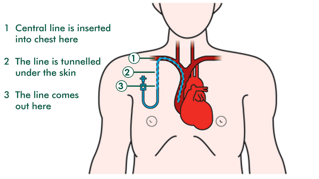 Hickman Catheter Site at Daniel Engle blog